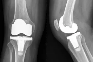 about total knee replacement